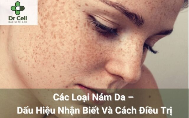 Các loại nám da