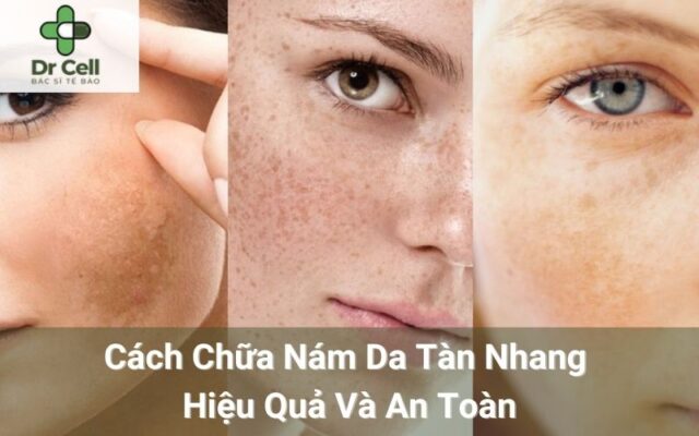 Cách chữa nám da tàn nhang