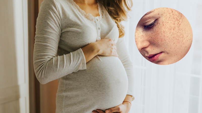 Nám da do mang thai