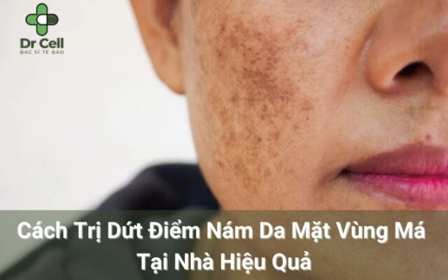 Nám da mặt vùng má