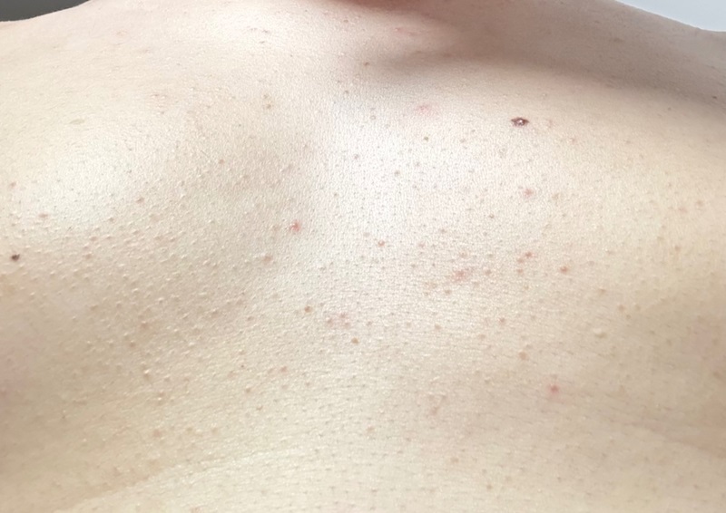 Mụn ở ngực là gì