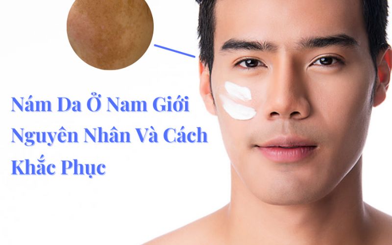 các phương pháp điều trị nám da cho nam 