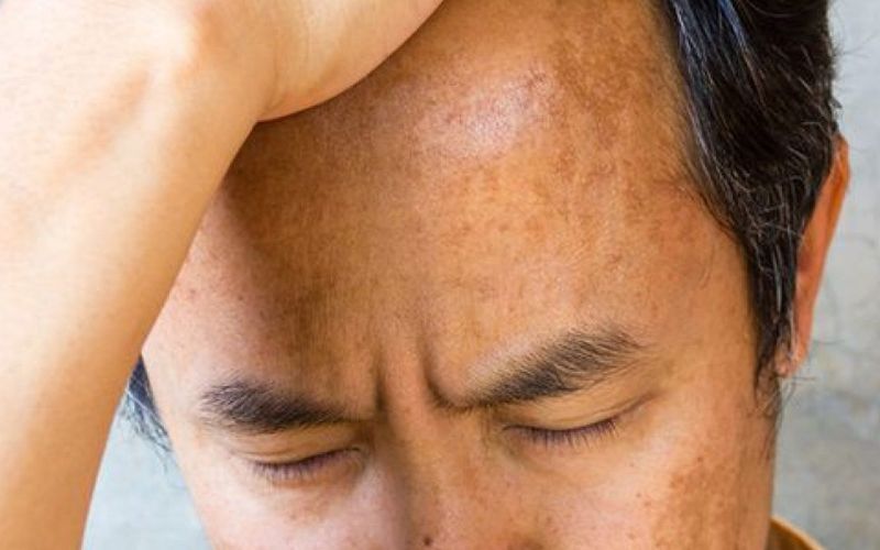 dấu hiệu nhận biết nám da ở nam giới
