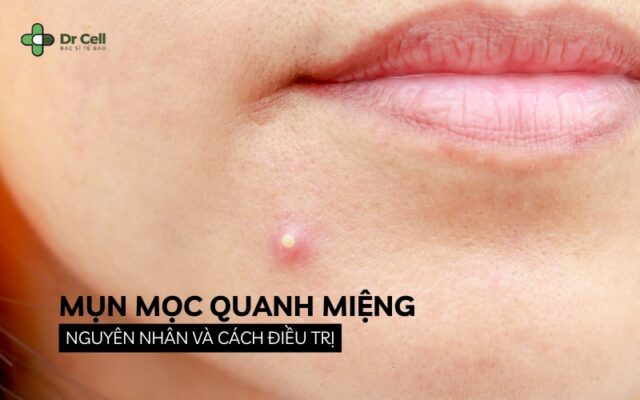 mụn mọc quanh miệng