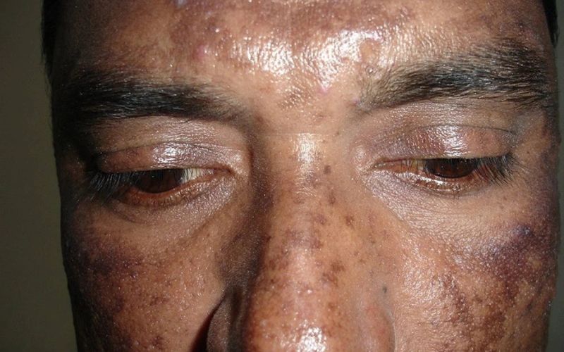 nguyên nhân gây nám da ở nam giới