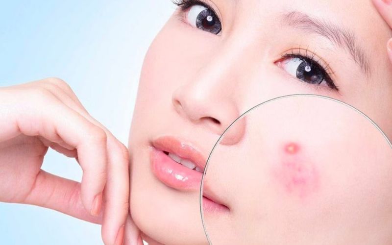 câu hỏi thường gặp về mụn bọc và cách điều trị