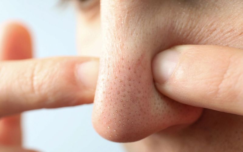 câu hỏi thường gặp về mụn đầu đen ở mũi