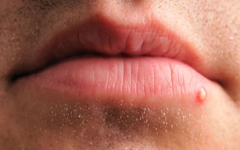 câu hỏi thường gặp về mụn mọc quanh miệng