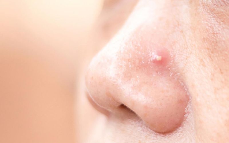 Lưu ý khi điều trị mụn trứng cá để tránh tái phát