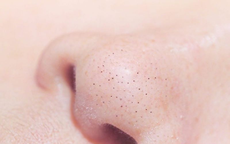 lưu ý khi sử dụng sản phẩm trị mụn đầu đen