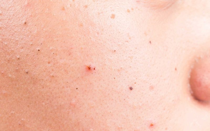 mụn ẩn ở má là gì