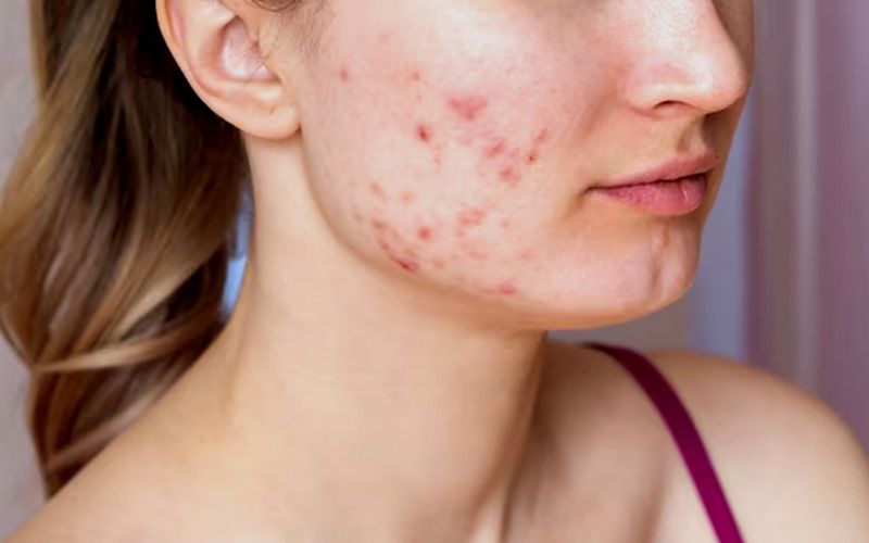 mụn bọc có tự xẹp không và thời gian cần thiết để mụn xẹp