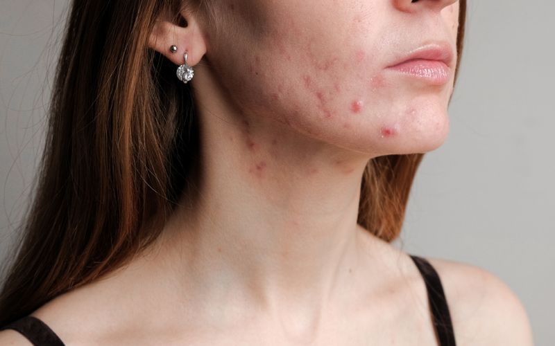 mụn nội tiết ở quai hàm là gì