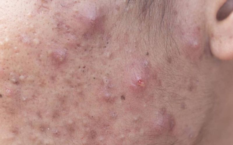 nguyên nhân chính gây mụn bọc