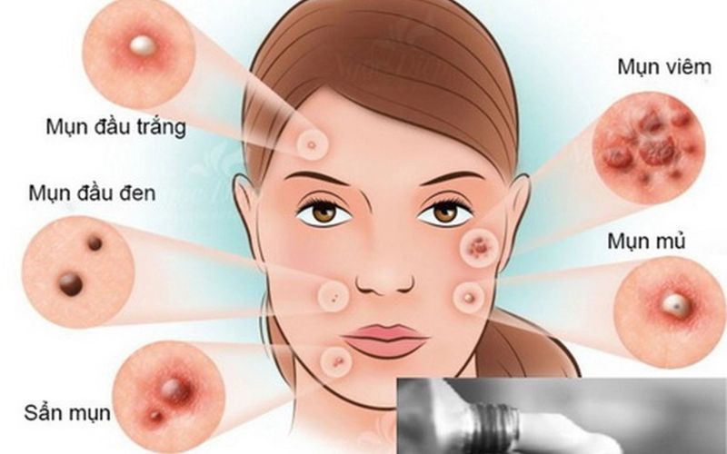 Nguyên nhân gây ra mụn trứng cá