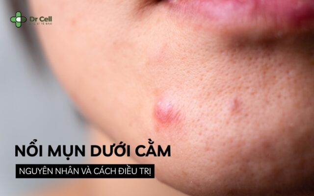 nổi mụn dưới cằm