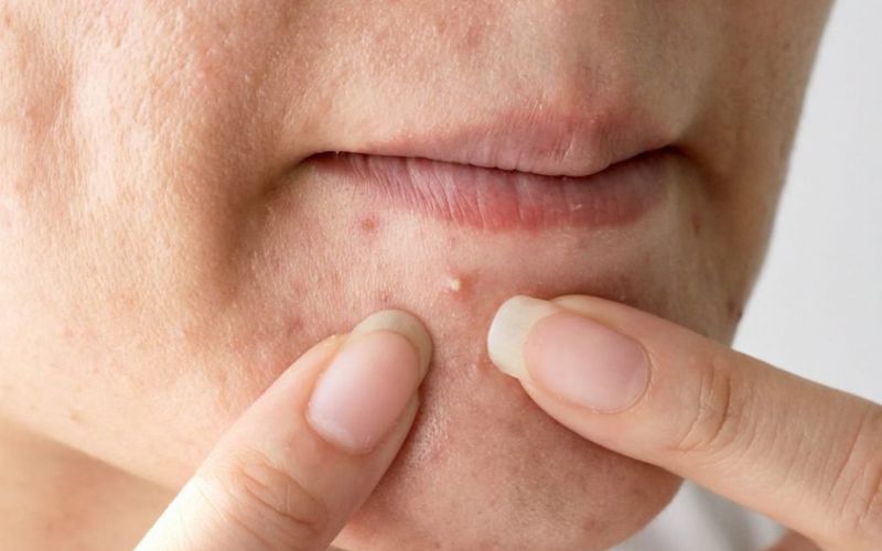 sản phẩm hỗ trợ điều trị mụn mọc quanh miệng từ drcell