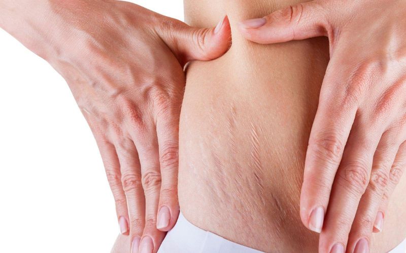 các yếu tố tăng nguy cơ rạn da lưng ở nam