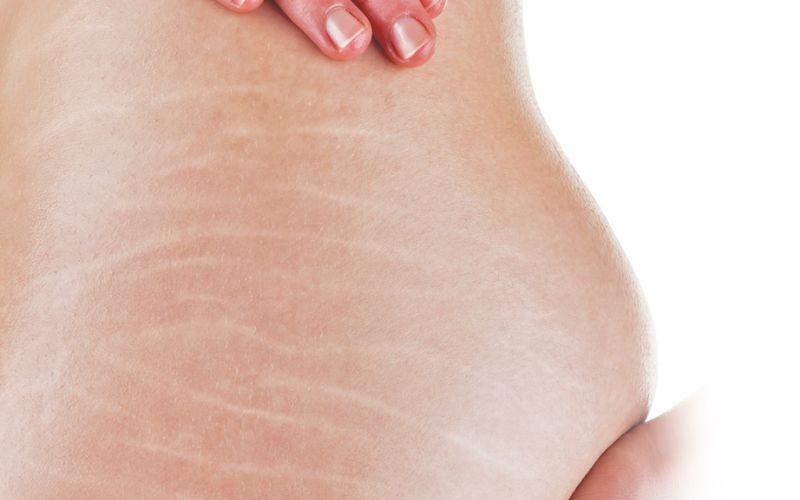 nguyên nhân gây rạn da lưng ở nam giới