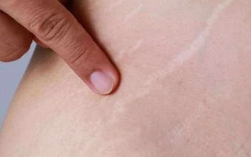 những câu hỏi thường gặp về rạn da lưng ở nam